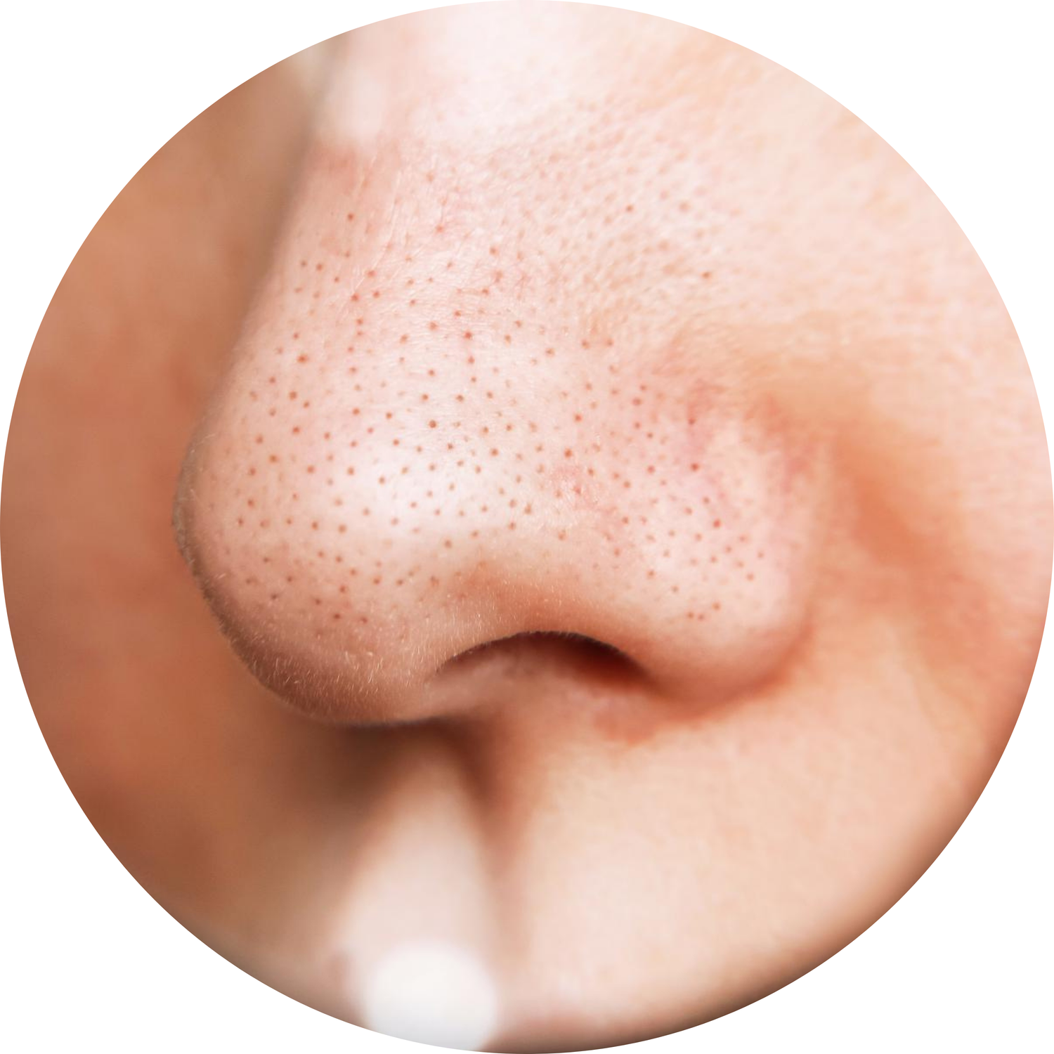 Blackheads