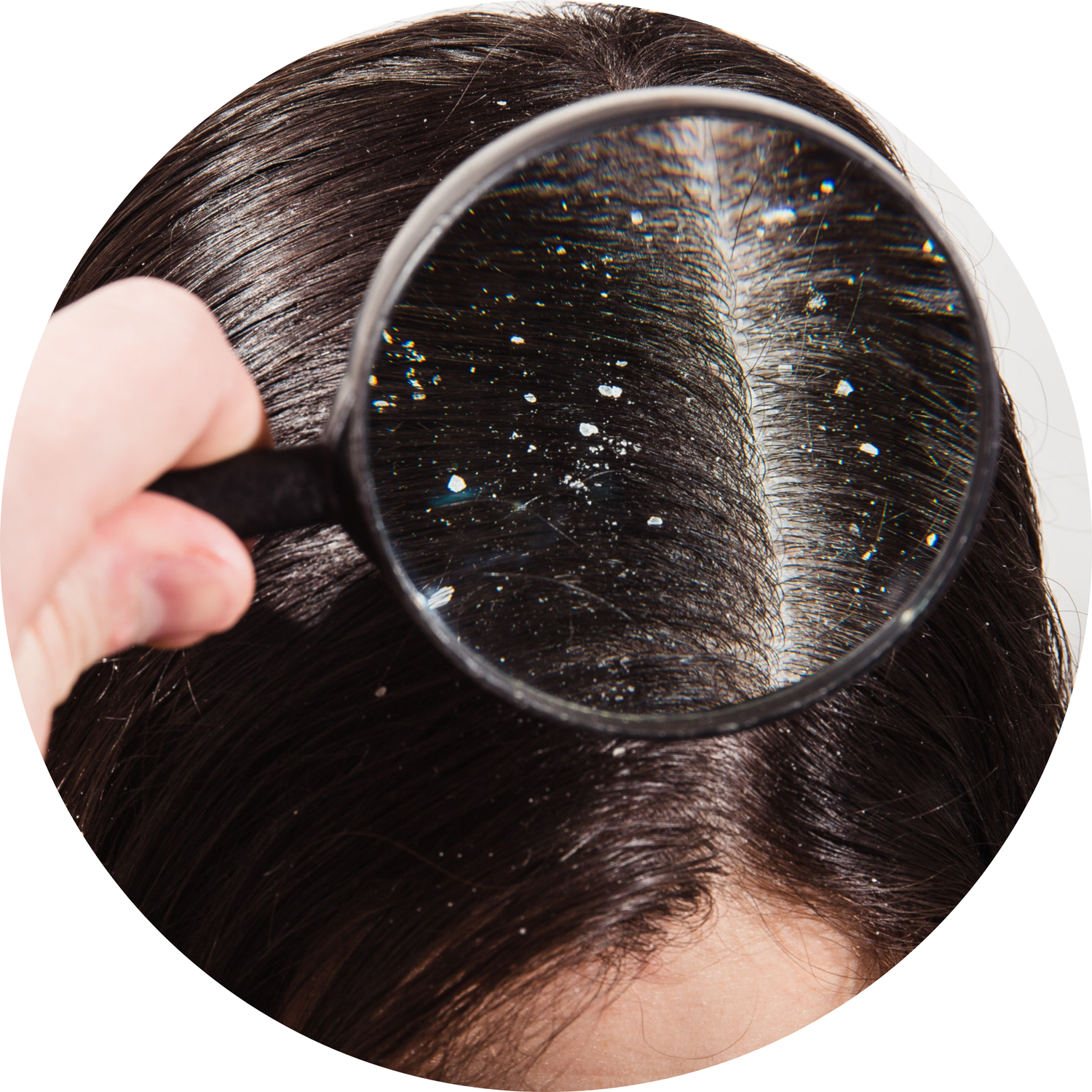 Hair Loss & Dandruff